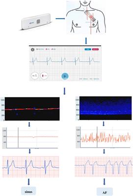 Long-term single-lead electrocardiogram monitoring to detect new-onset postoperative atrial fibrillation in patients after cardiac surgery